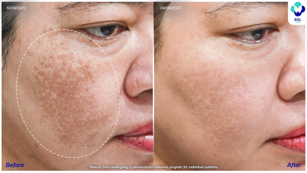 เคสฝ้าสีผิวดูกลมกลืนขึ้น