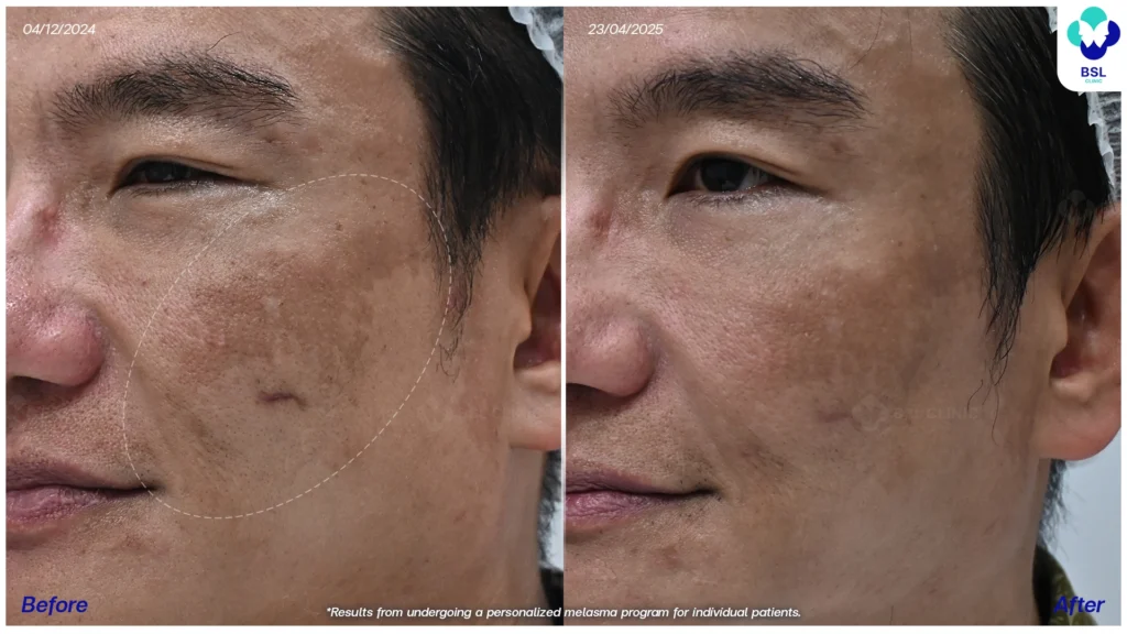 รีวิวรักษาฝ้า