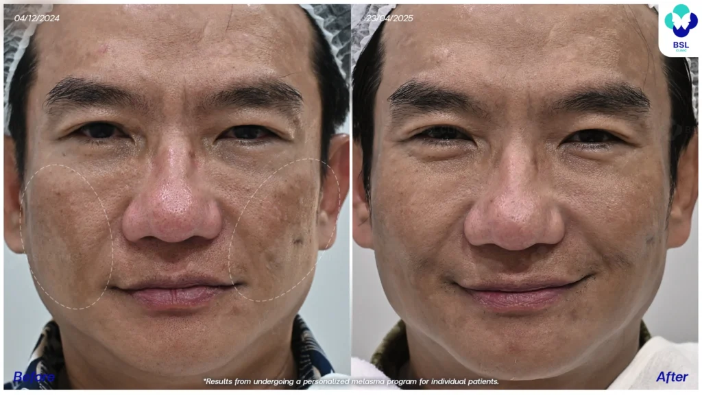 เคสฝ้าในผู้รับบริการจริง