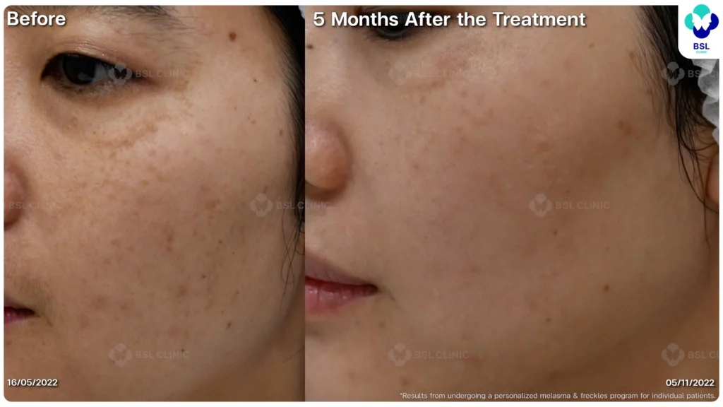 เคสฝ้าในผู้รับบริการจริง