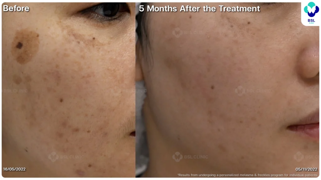 เคสฝ้าในผู้รับบริการจริง