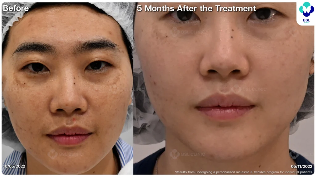 เคสฝ้าในผู้รับบริการจริง