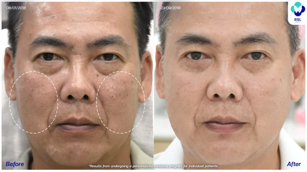 เส้นทางดูแลฝ้าของแต่ละเคส