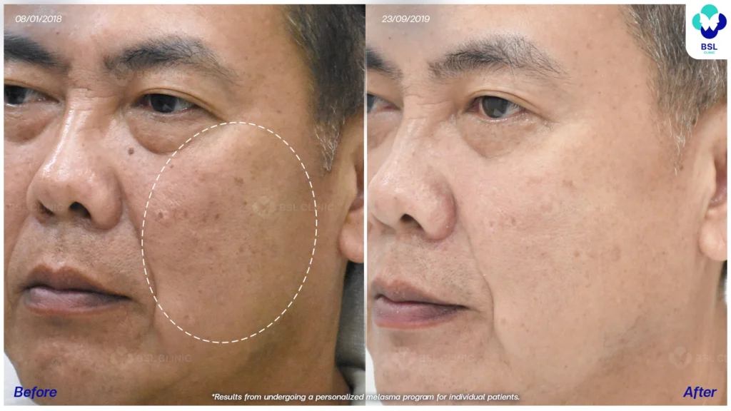 เส้นทางดูแลฝ้าของแต่ละเคส