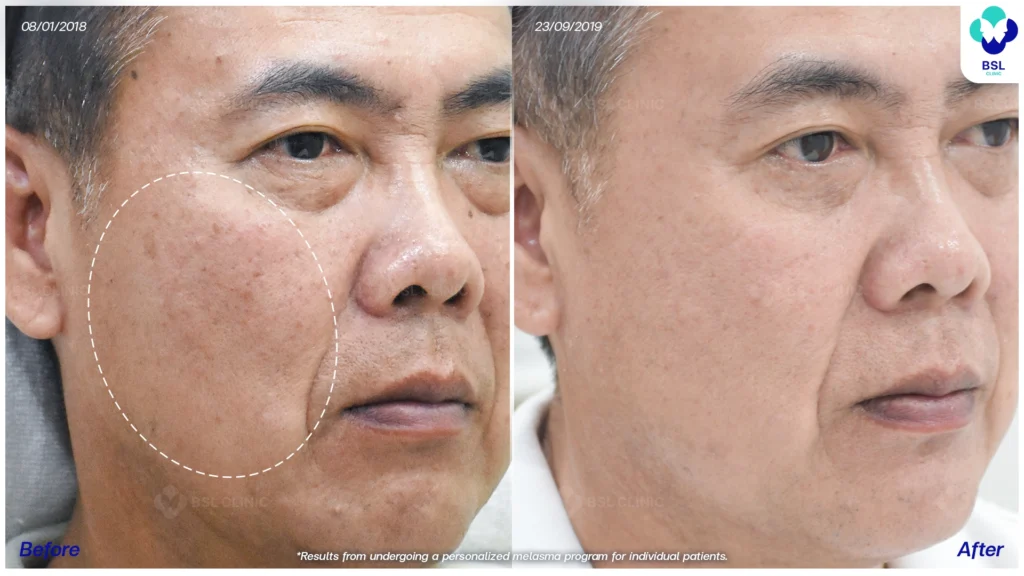 เส้นทางดูแลฝ้าของแต่ละเคส