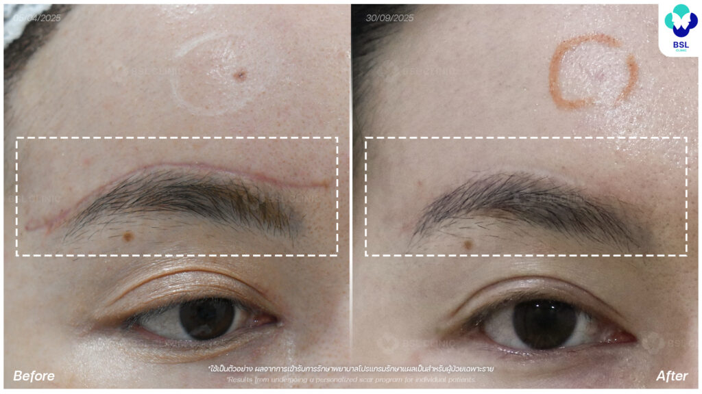 รีวิวรักษาแผลเป็น