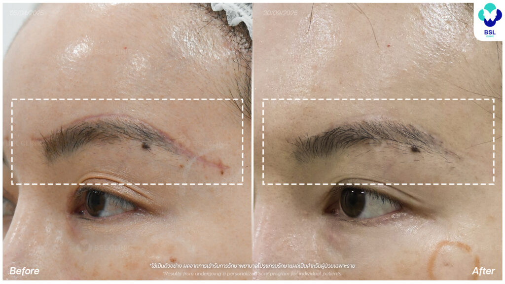 ตัวอย่างผลลัพธ์แผลเป็นเฉพาะบุคคล