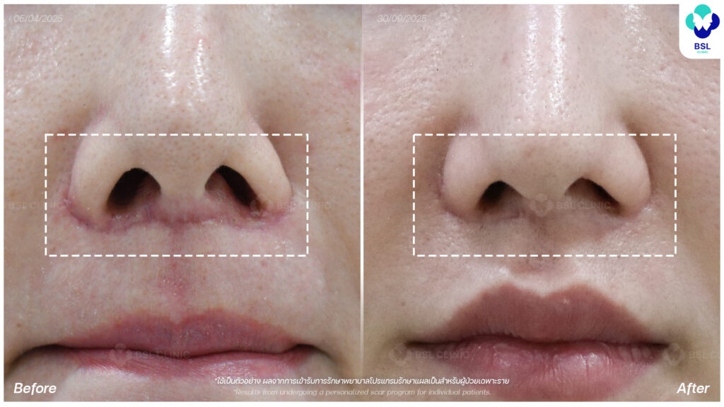 รีวิวรักษาแผลเป็น