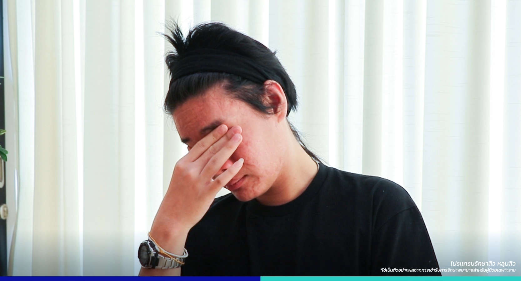 รีวิวรักษาหลุมสิว