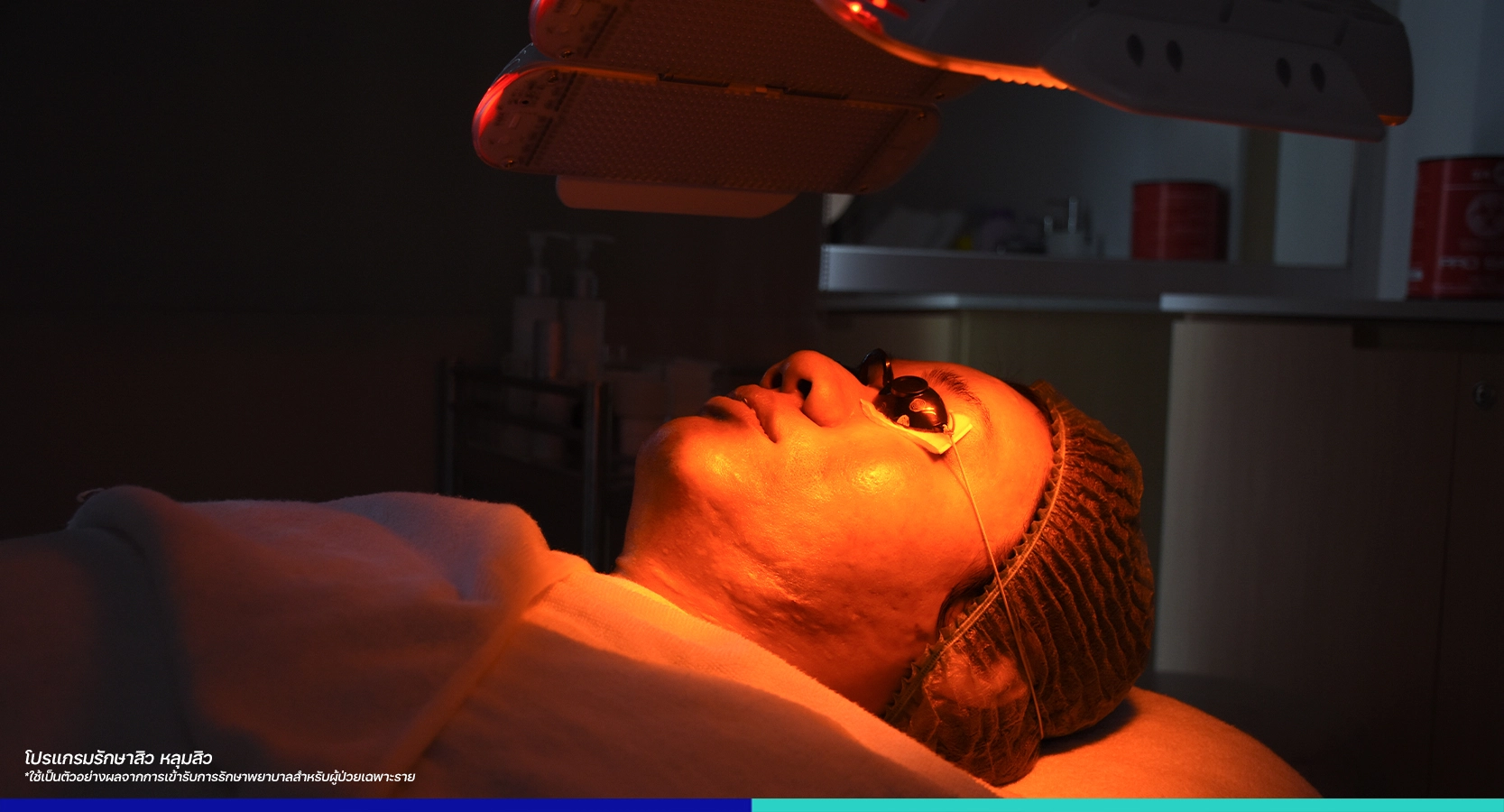 รีวิวรักษาสิว