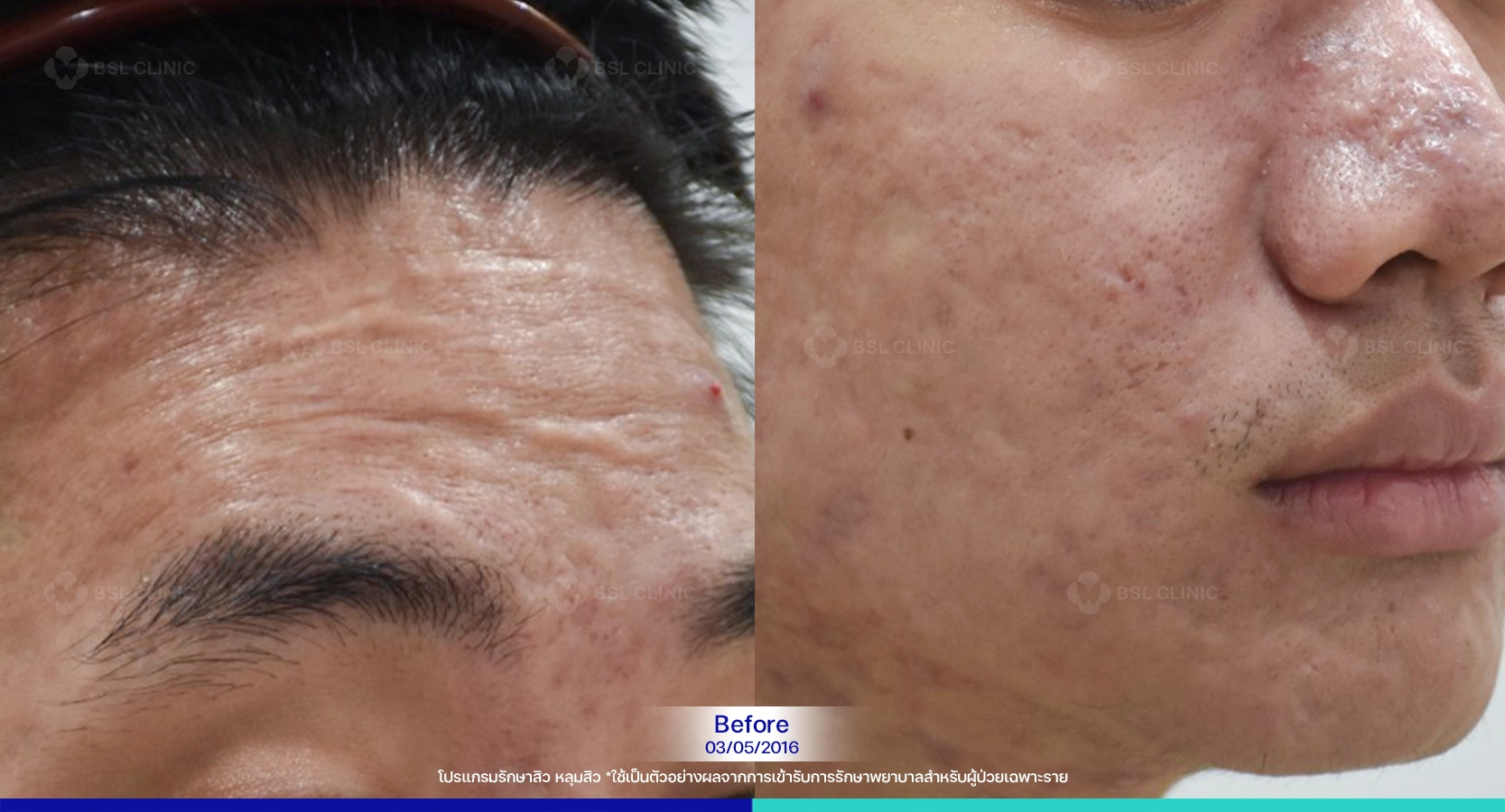 รีวิวรักษาหลุมสิว