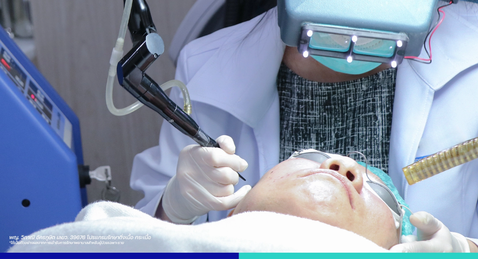 รีวิวเลเซอร์ติ่งเนื้อ