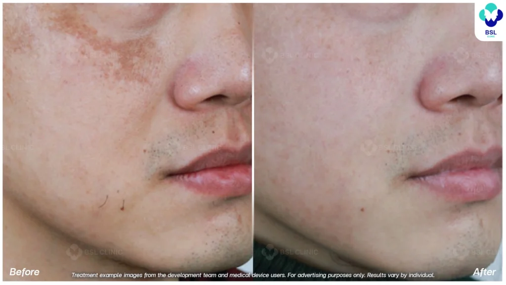 ตัวอย่างกระบริเวณแก้ม