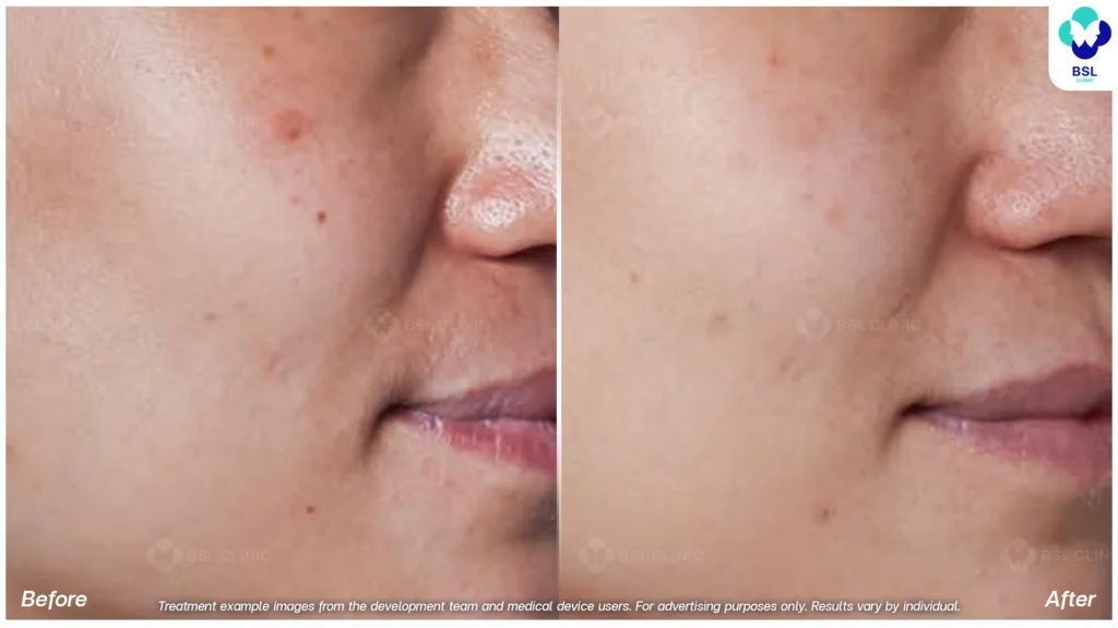 ตัวอย่างกระบริเวณแก้ม