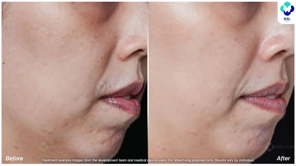 ตัวอย่างกระบริเวณแก้ม