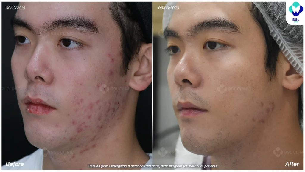 รักษาสิวกรอบหน้า