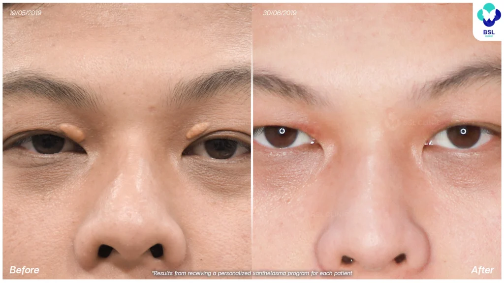 รีวิวรักษาต่อมไขมัน