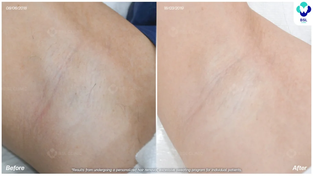 รีวิวรักแร้เนียน