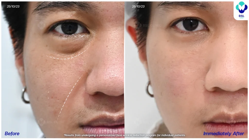 รีวิวลดริ้วรอยร่องแก้ม