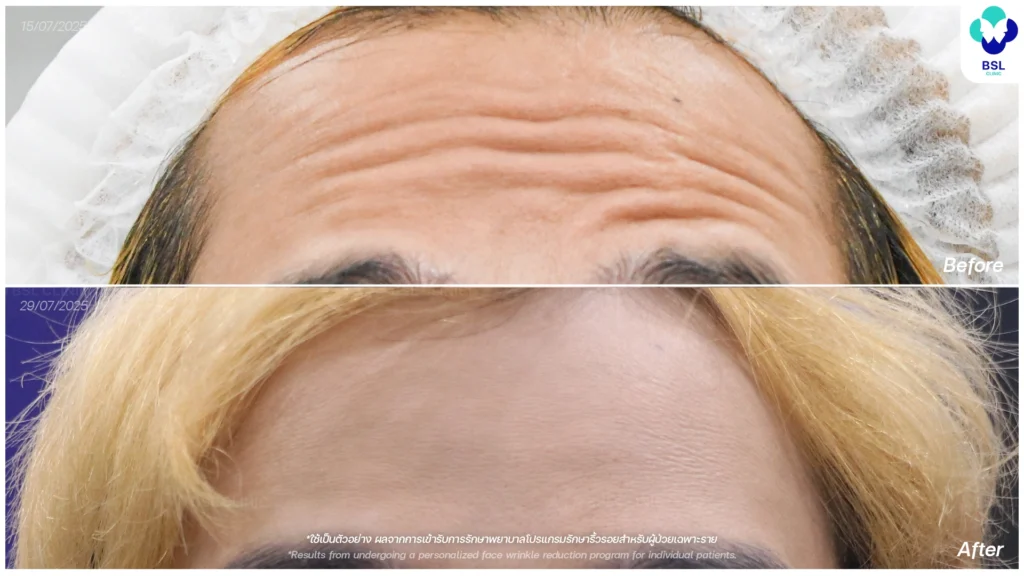 รีวิวลดริ้วรอยหน้าผาก