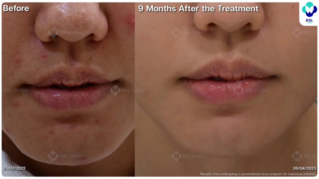 หน้าไม่เนียน