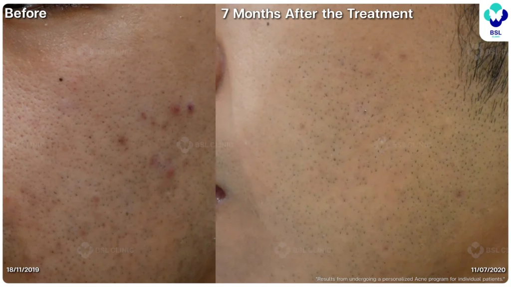 รักษาสิว