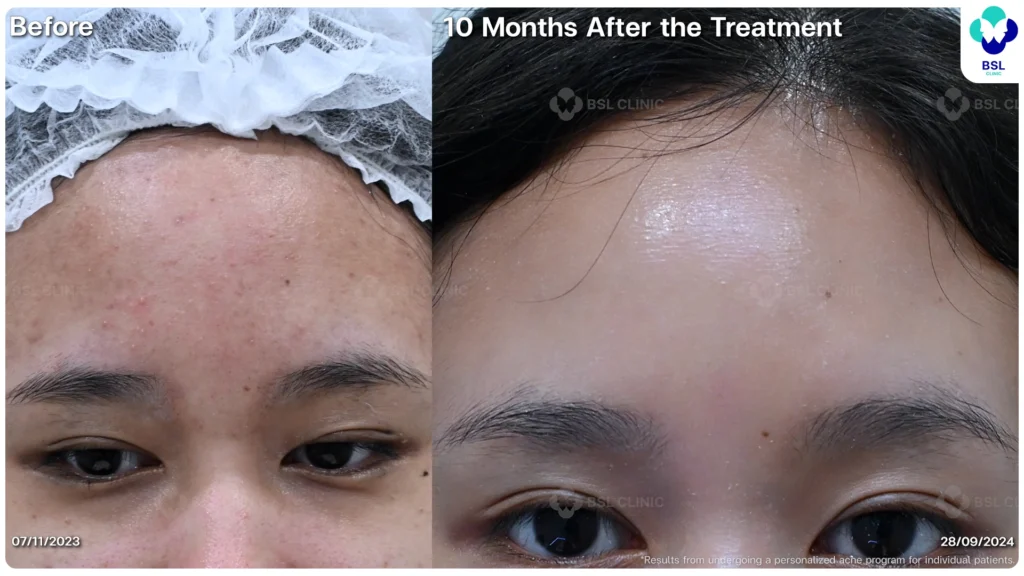 รีวิวสิว