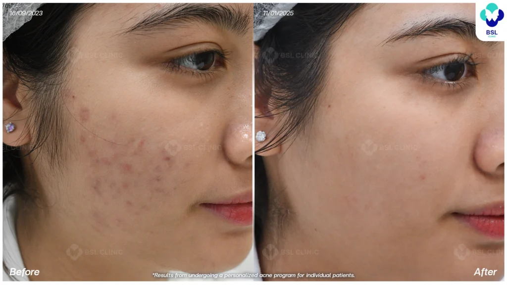 สิวที่แก้ม