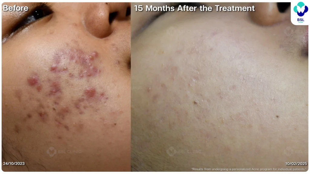 สิวอักเสบ