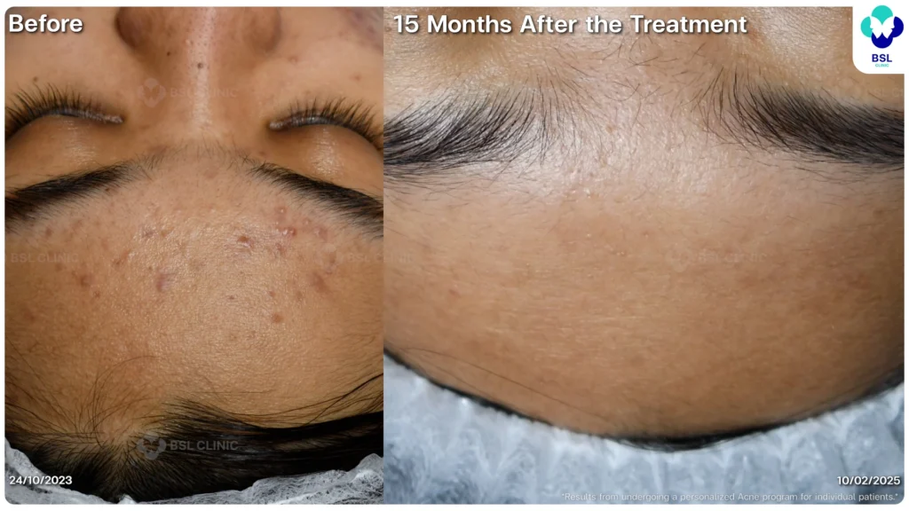 สิวอักเสบ