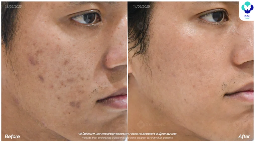 รีวิวรักษารอยดำสิว