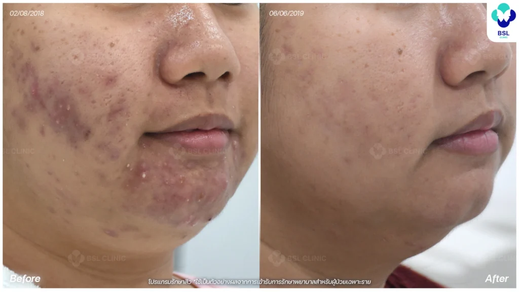 รีวิวสิวฮอร์โมนที่คาง