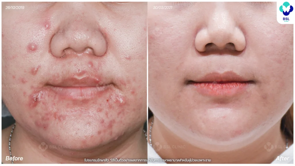 รีวิวสิวฮอร์โมนที่คาง