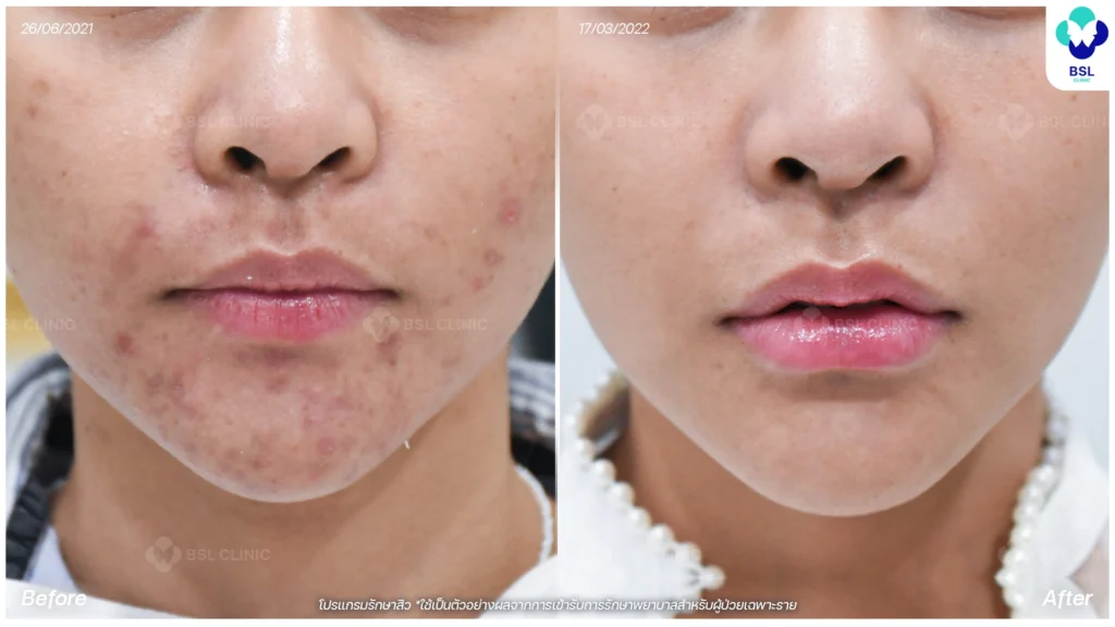 รีวิวสิวฮอร์โมน