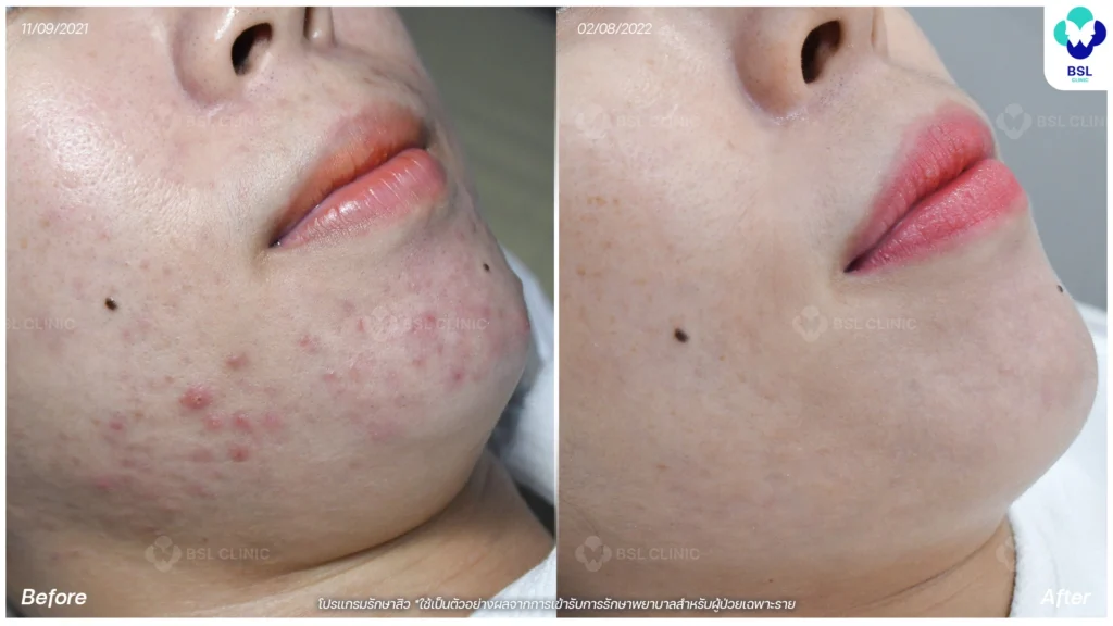 รีวิวสิวฮอร์โมน