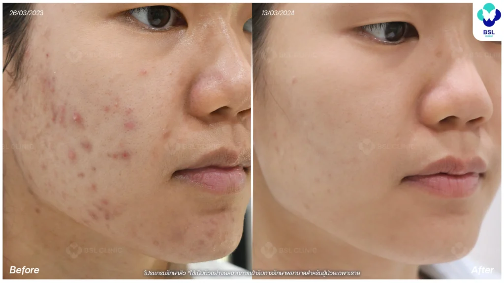 สิวฮอร์โมน