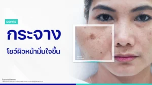 รีวิวกระฝ้า