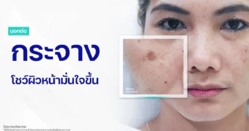 รีวิวกระฝ้า