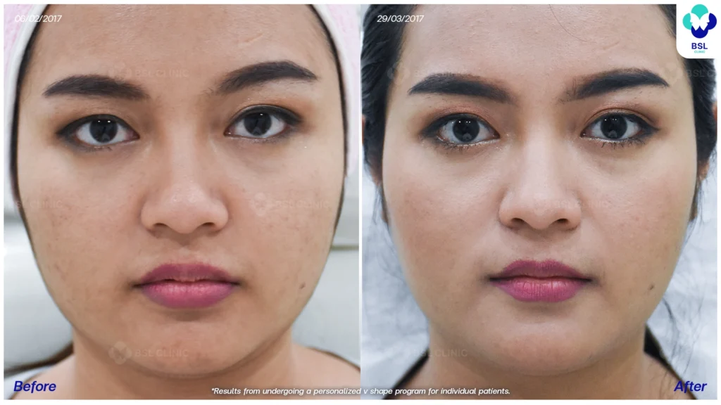 รีวิวยกกระชับปรับรูปหน้า