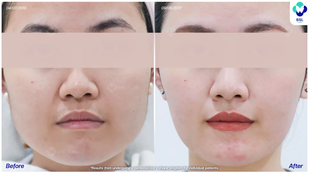 รีวิวยกกระชับปรับรูปหน้า