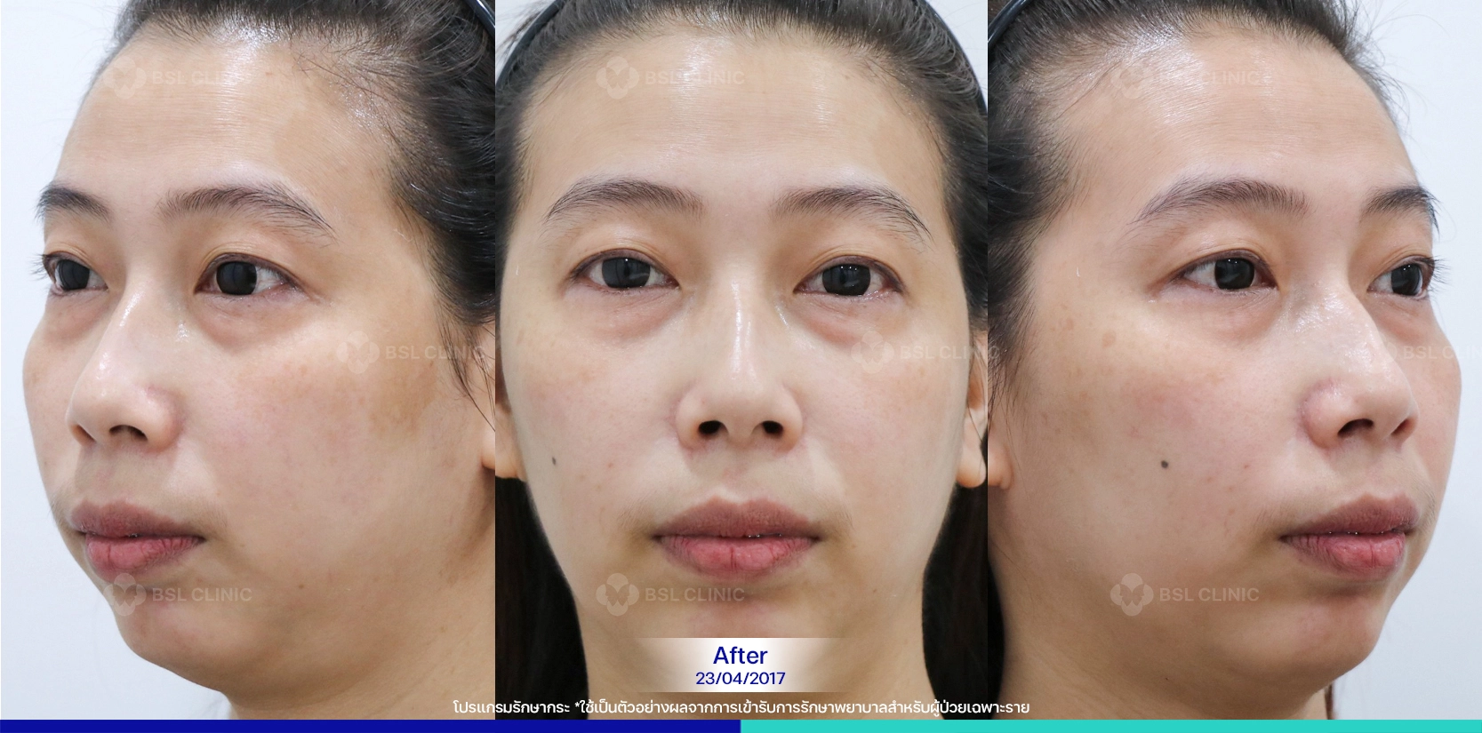 รีวิวเลเซอร์กระตื้น