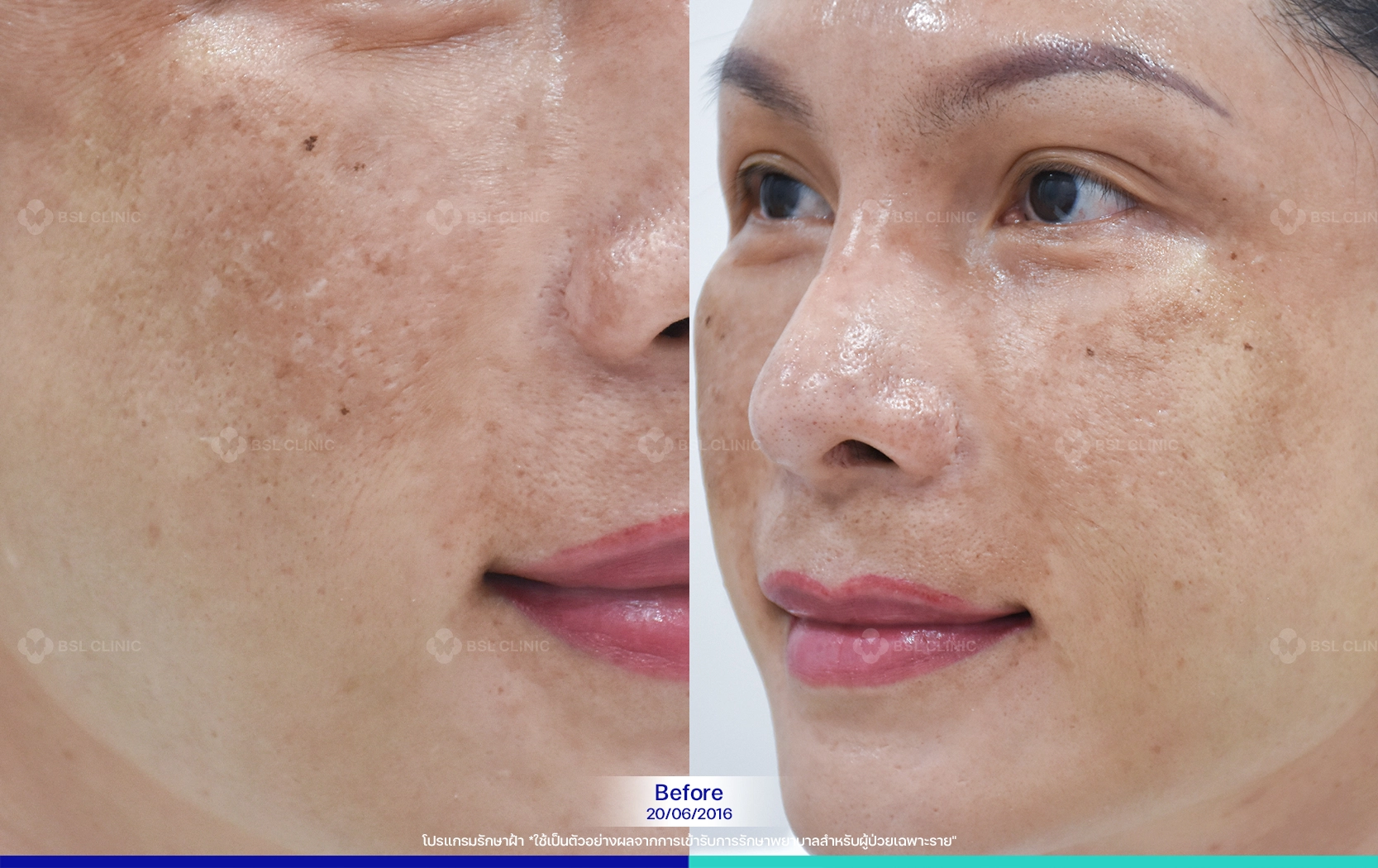 รักษาฝ้า