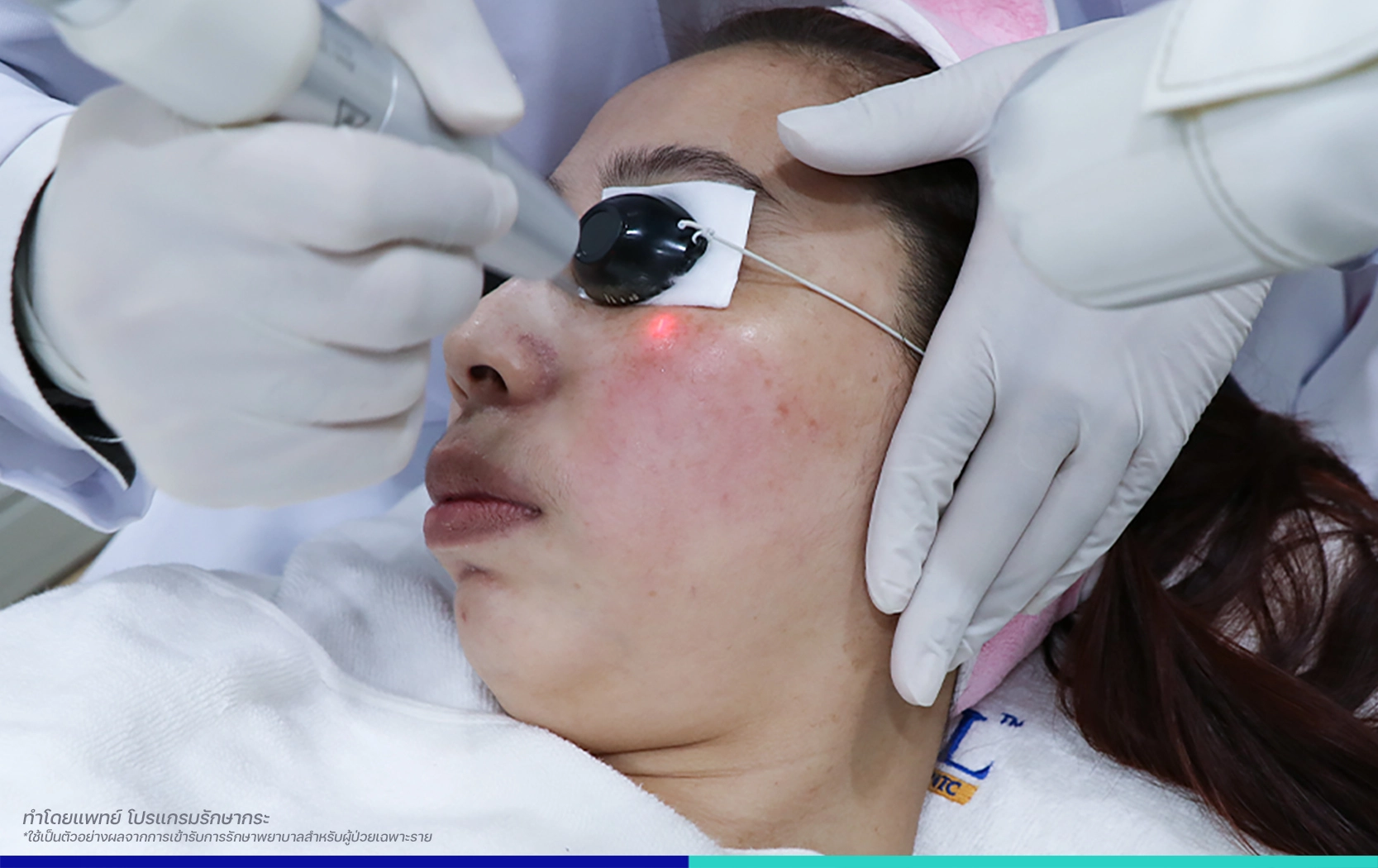 รีวิวเลเซอร์กระตื้น