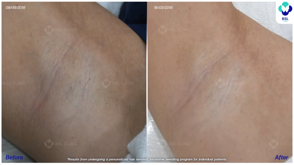 รีวิวรักแร้กระจ่างใสขึ้น