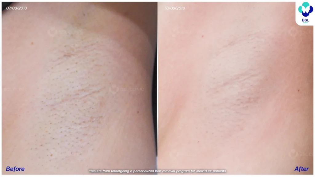 รีวิวรักแร้เนียน