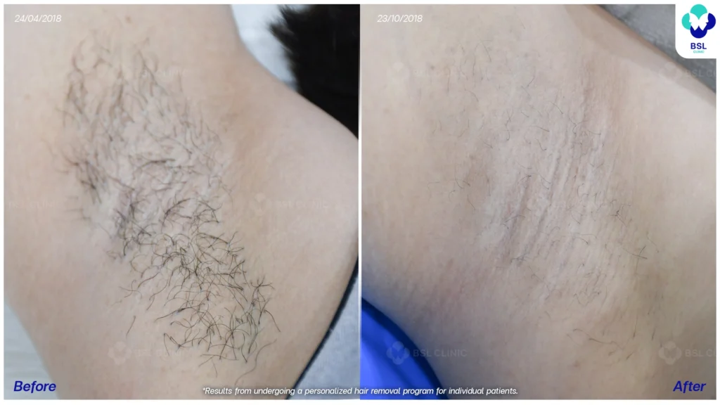 รีวิวรักแร้กระจ่างใสขึ้น