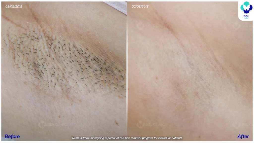 รีวิวรักแร้เนียน