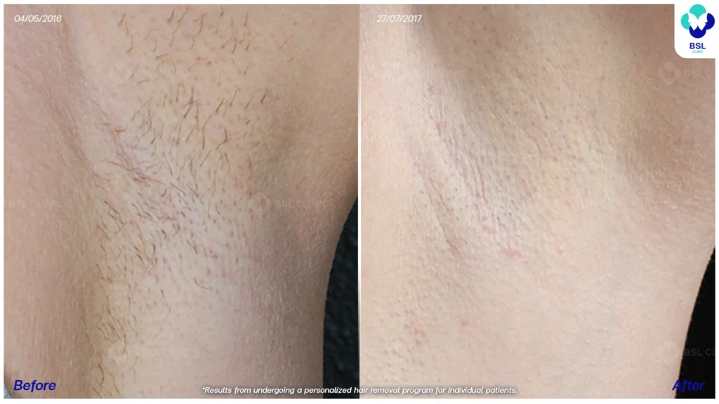 รีวิวรักแร้เนียน