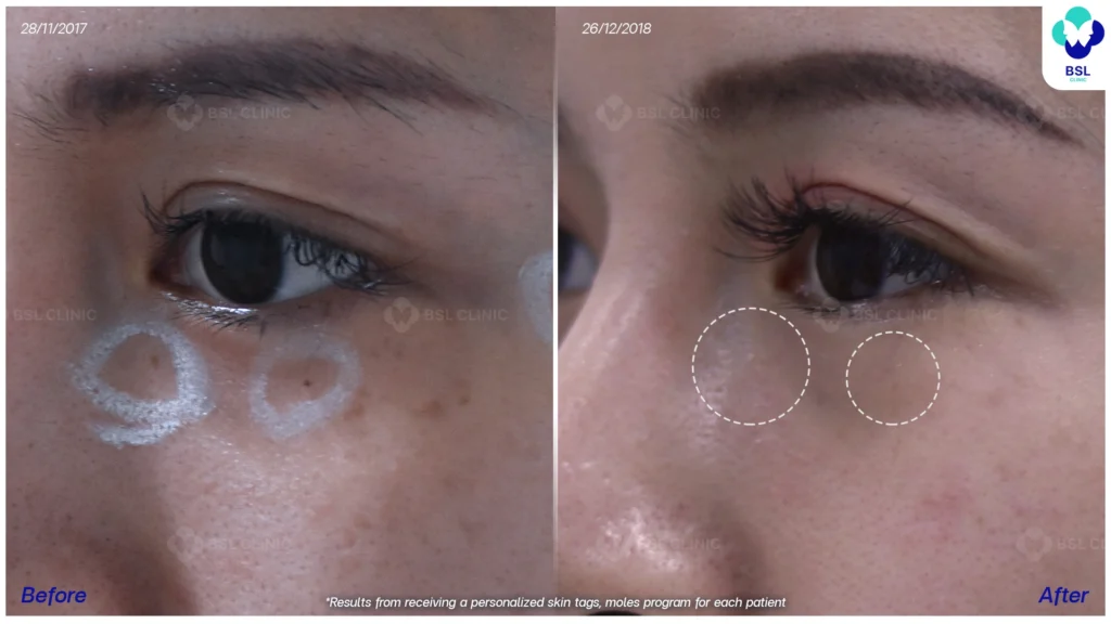 รีวิวรักษาขี้แมลงวัน