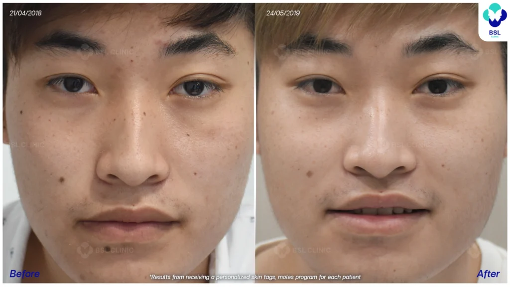 เลเซอร์รักษาไฝ ขี้แมลงวัน ติ่งเนื้อ กระเนื้อ